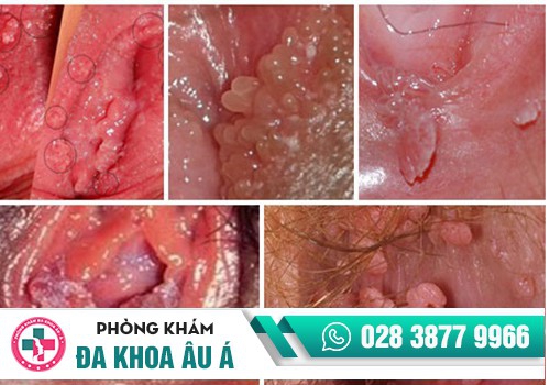 Hình ảnh sùi mào gà ở âm đạo phụ nữ