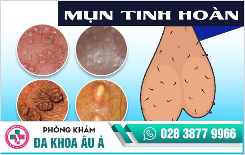mụn tinh hoàn