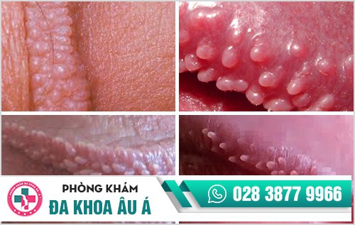 Tất cả những thông tin liên quan đến chuỗi hạt ngọc dương vật