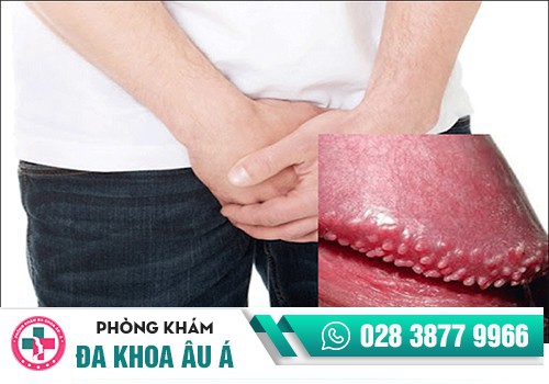 Điều trị bao quy đầu nổi hạt bằng cách nào?