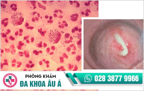 Cẩn thận với hiện tượng tiểu ra mủ để tránh nguy cơ vô sinh