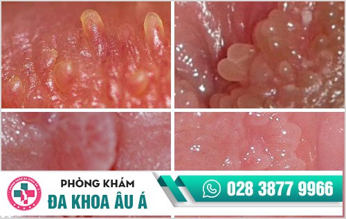 Nỗi lo khi xuất hiện thịt dư âm đạo