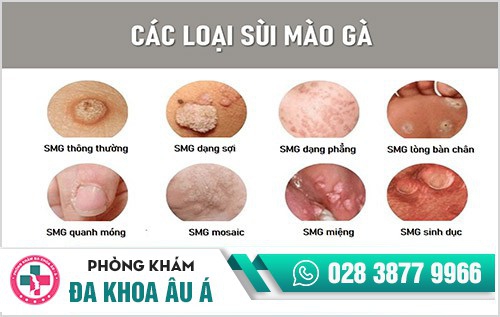 Cách nhận biết sùi mào gà, Nhận biết sùi mào gà bằng cách nào