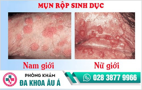 Herpes sinh dục