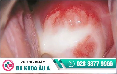 Âm đạo chảy mủ - cảnh giác với nguy cơ mắc bệnh lậu
