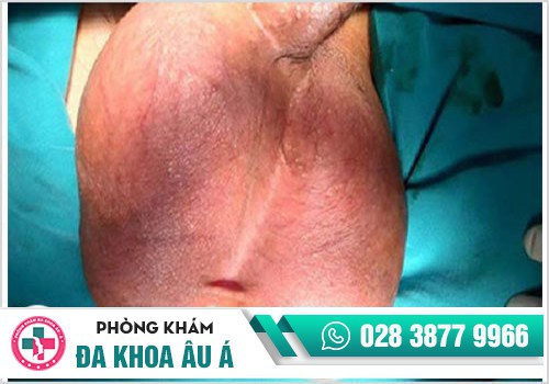 Triệu chứng chấn thương tinh hoàn