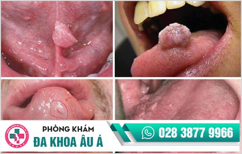 Bạn đã biết gì về bệnh sùi mào gà ở lưỡi