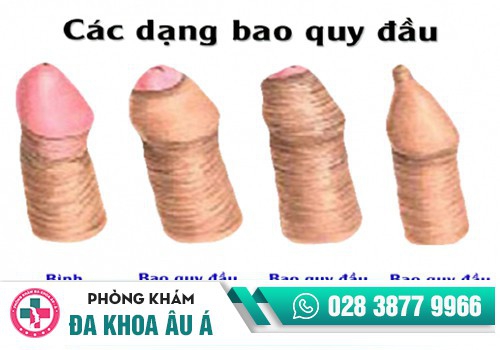 NGUYÊN NHÂN NÀO GÂY KHÓ TRONG VIỆC TUỘT BAO QUY ĐẦU?
