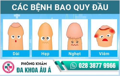 Cắt da bao quy đầu là gì?