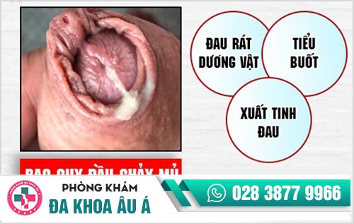 Bao quy đầu chảy mủ - cẩn thận bệnh lậu