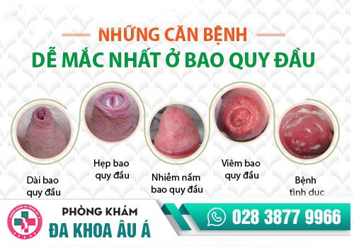 Bệnh lý bao quy đầu dẫn đến tình trạng bí tiểu