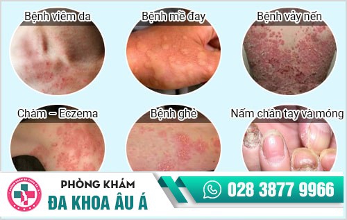 Nhận biết các bệnh da liễu thường gặp