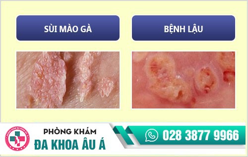 Bệnh dương vật