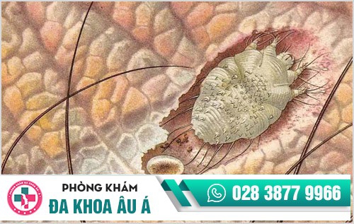 Mụn cóc ở chân khi nào cần điều trị?