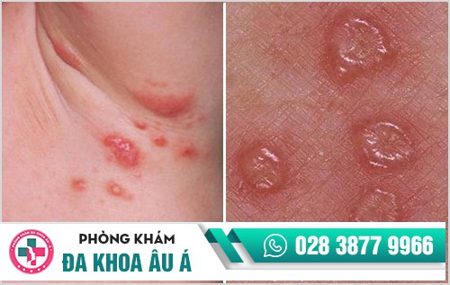 Hình ảnh bệnh ghẻ phỏng