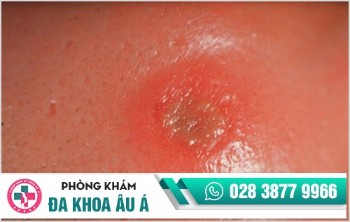 Thuốc điều trị bệnh giang mai có những loại nào? Hiệu quả ra sao?