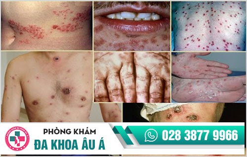 Thuốc điều trị bệnh giang mai có những loại nào? Hiệu quả ra sao?