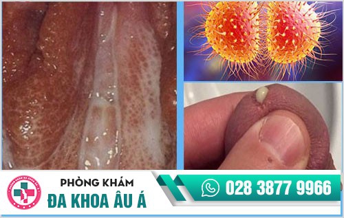 Bệnh kim la có phải là bệnh lậu?