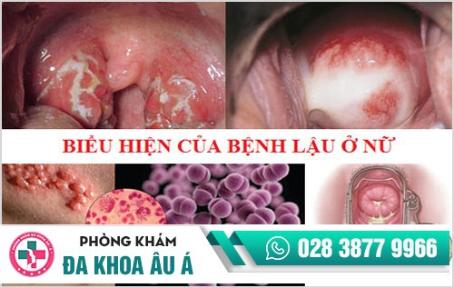 Biểu hiện bệnh lậu - đa số đều không biết đến thông tin này
