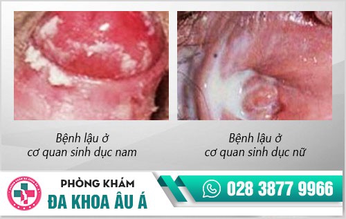 bệnh lậu có thể chữa được không