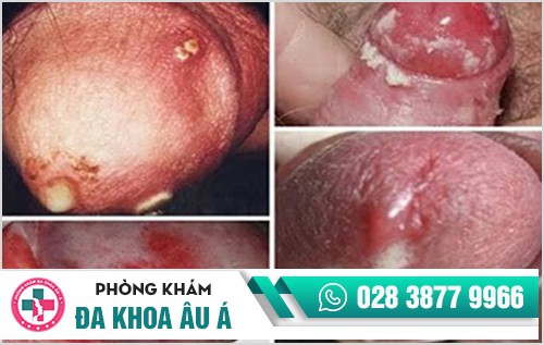 Bệnh lậu dấu hiệu và cách điều trị hiệu quả