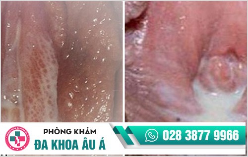 Bệnh lậu dấu hiệu và cách điều trị hiệu quả