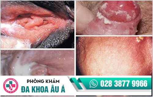 Cận cảnh hình ảnh bệnh lậu ở các vị trí trên cơ thể