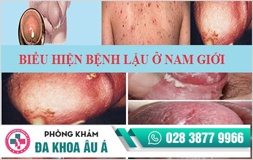 Bệnh lậu: Dấu hiệu và cách hỗ trợ điều trị hiệu quả　　
