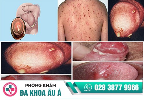 Xét nghiệm bệnh xã hội