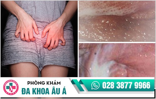 Bệnh lậu nữ và những nguy hiểm cần biết