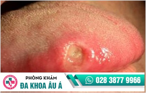 Bệnh lậu ở miệng 