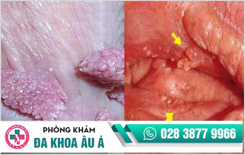 bệnh lây qua đường quan hệ tình dục