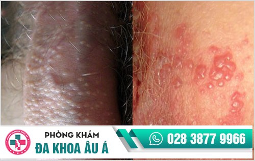 bệnh lây qua đường quan hệ tình dục