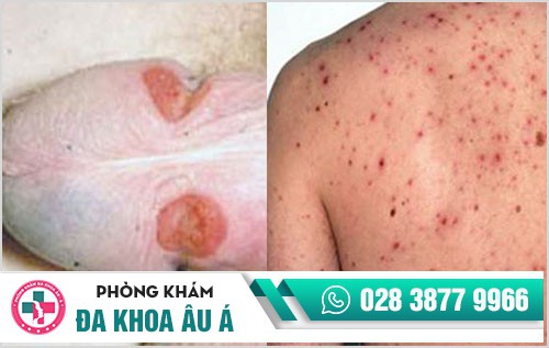 bệnh lây qua đường quan hệ tình dục