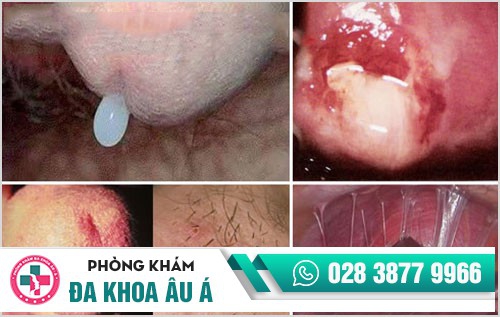 bệnh lây qua đường quan hệ tình dục