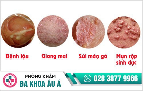 Bệnh lây qua đường tình dục - Chuyện không phải ai cũng biết