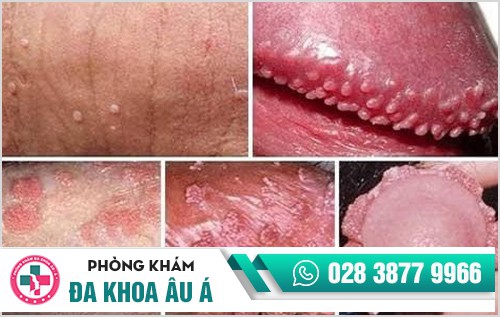 Bệnh mồng gà là bệnh như thế nào?