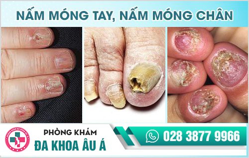 nấm móng tay, nấm móng chân
