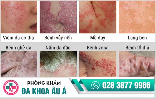 Chữa bệnh ngoài da