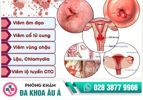 Chậm kinh ra máu nâu có thể do mắc bệnh phụ khoa