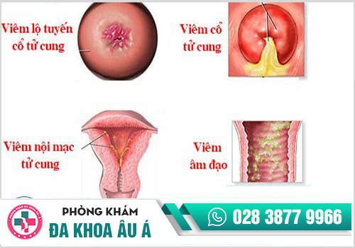 Chậm kinh ra máu nâu là bị làm sao?