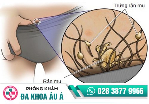 NGỨA VÙNG KÍN LÀ BỊ BỆNH GÌ?