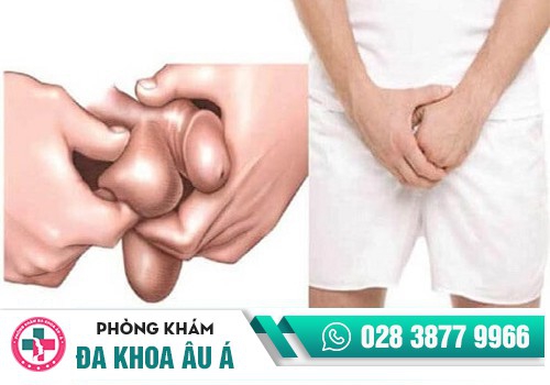 Bệnh sa đì là gì?