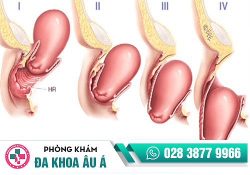 Nguyên nhân gây ra bệnh sa đì là gì?