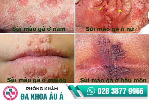 test nhanh sùi mào gà