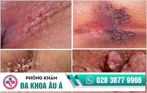 bệnh sùi mào gà ở hậu môn