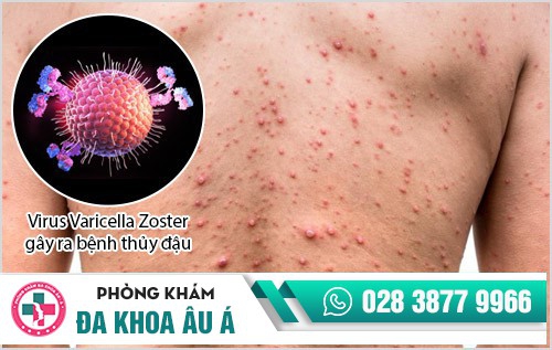 bệnh thủy đậu