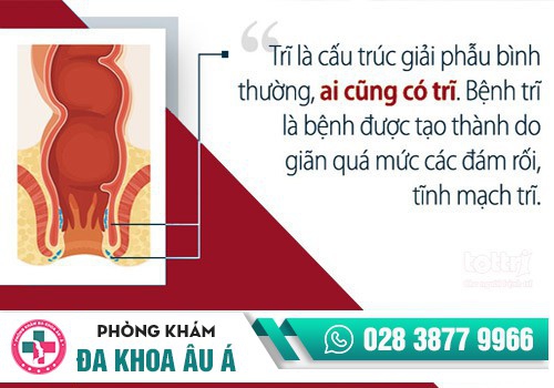 Phân loại bệnh trĩ