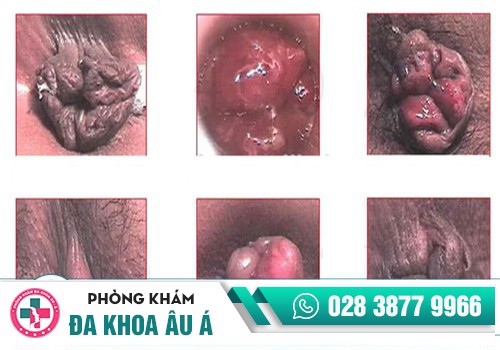 Cục thịt dư lồi ra ở hậu môn là biểu hiện của bệnh gì?