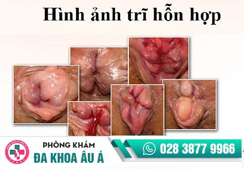HÌNH ẢNH BỆNH TRĨ HỖN HỢP